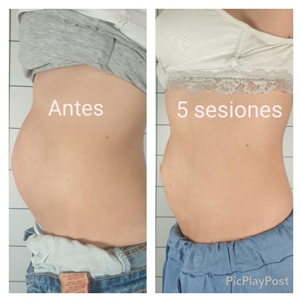 Recuperación abdominal tras embarazo Abdominoplastia Multiestetica