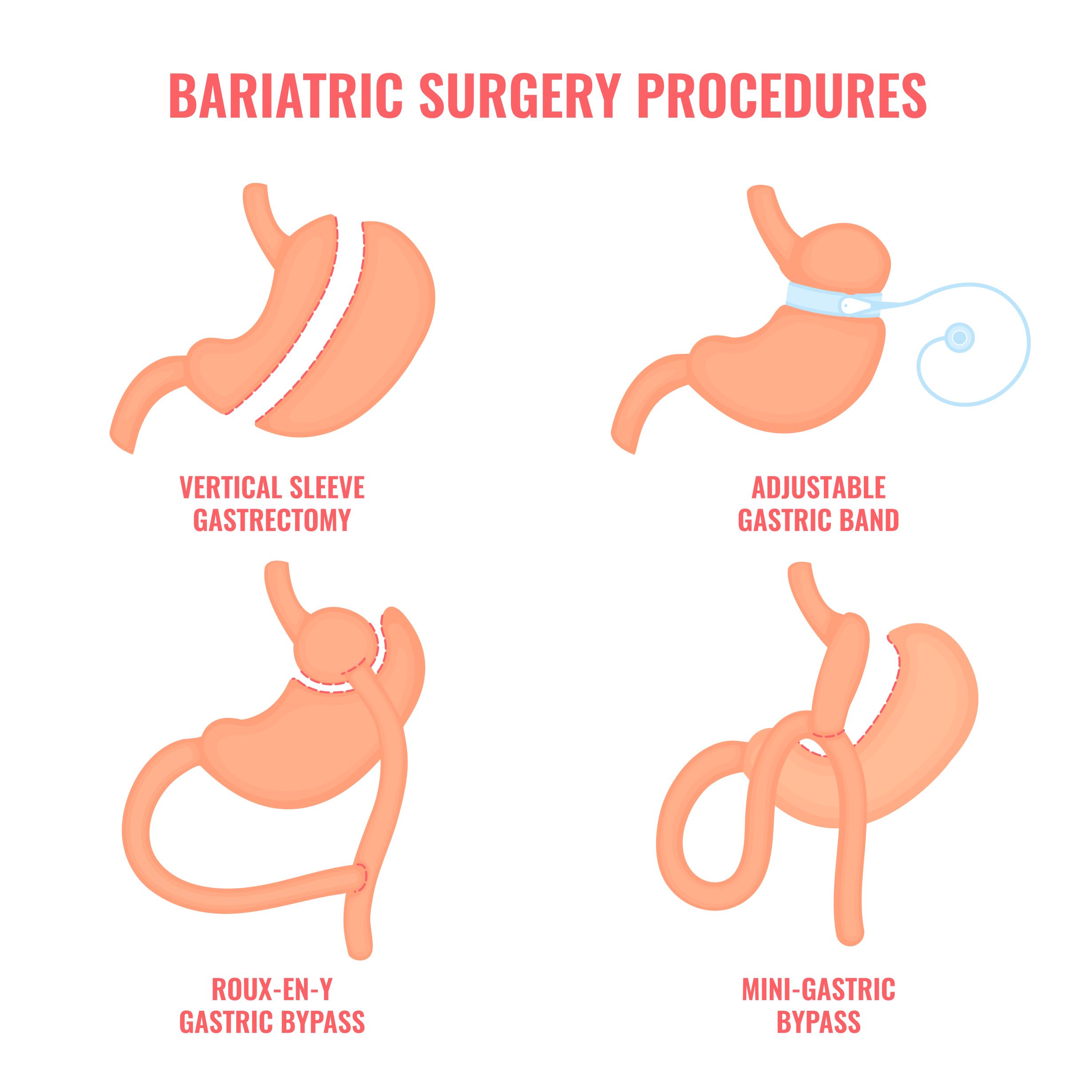 Cirugía bariátrica
