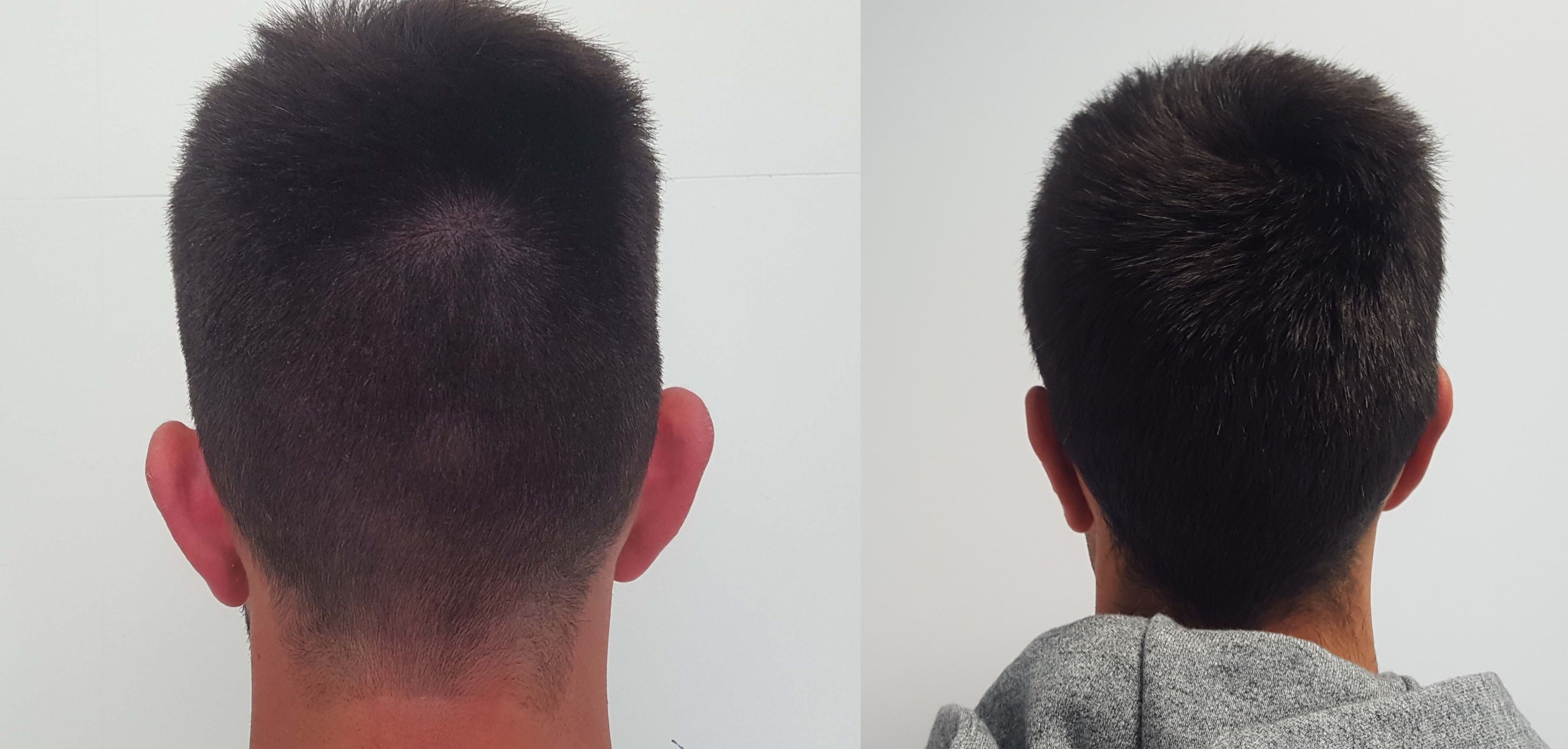 Antes y después otoplastia