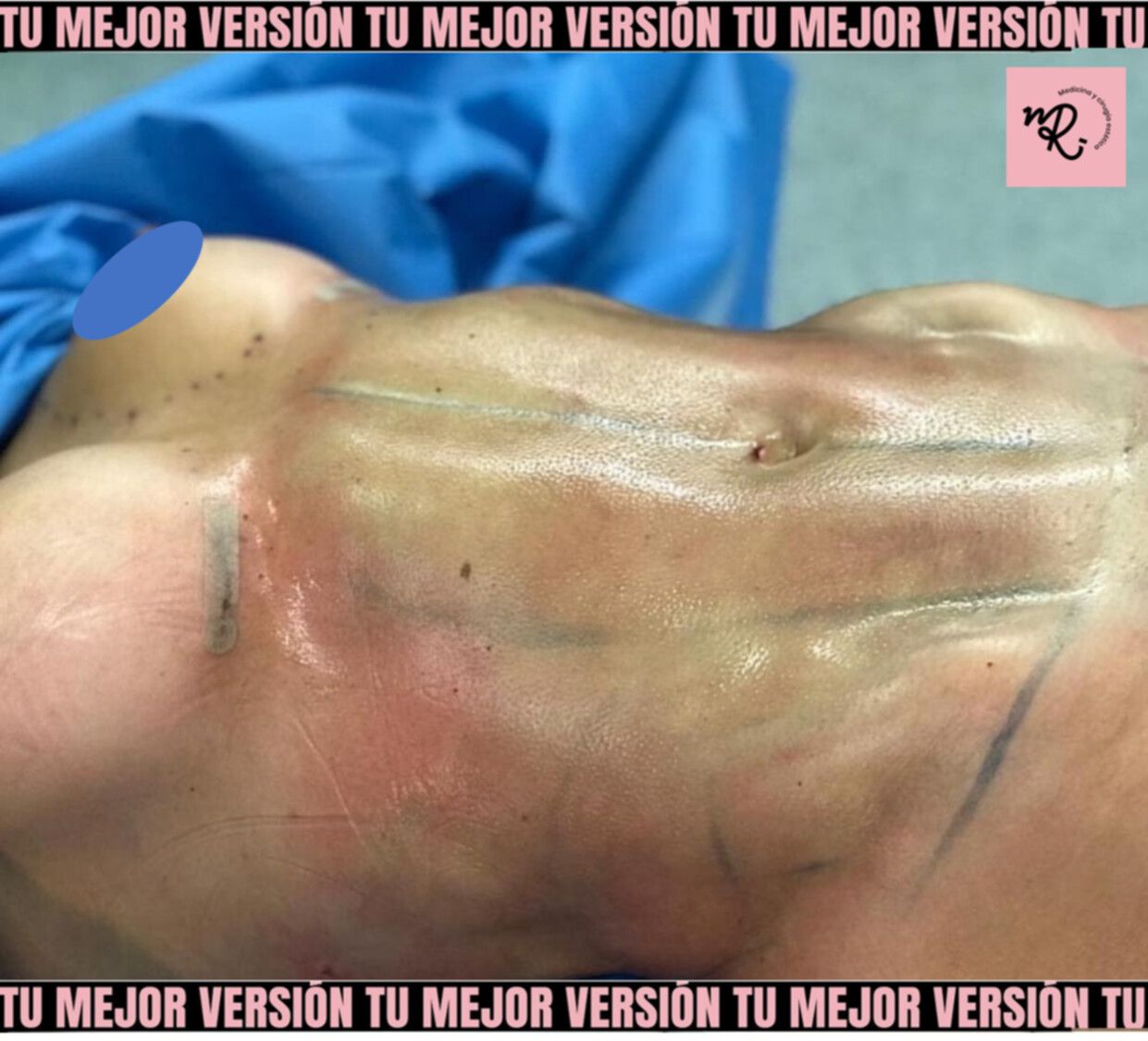 liposucción j-plasma