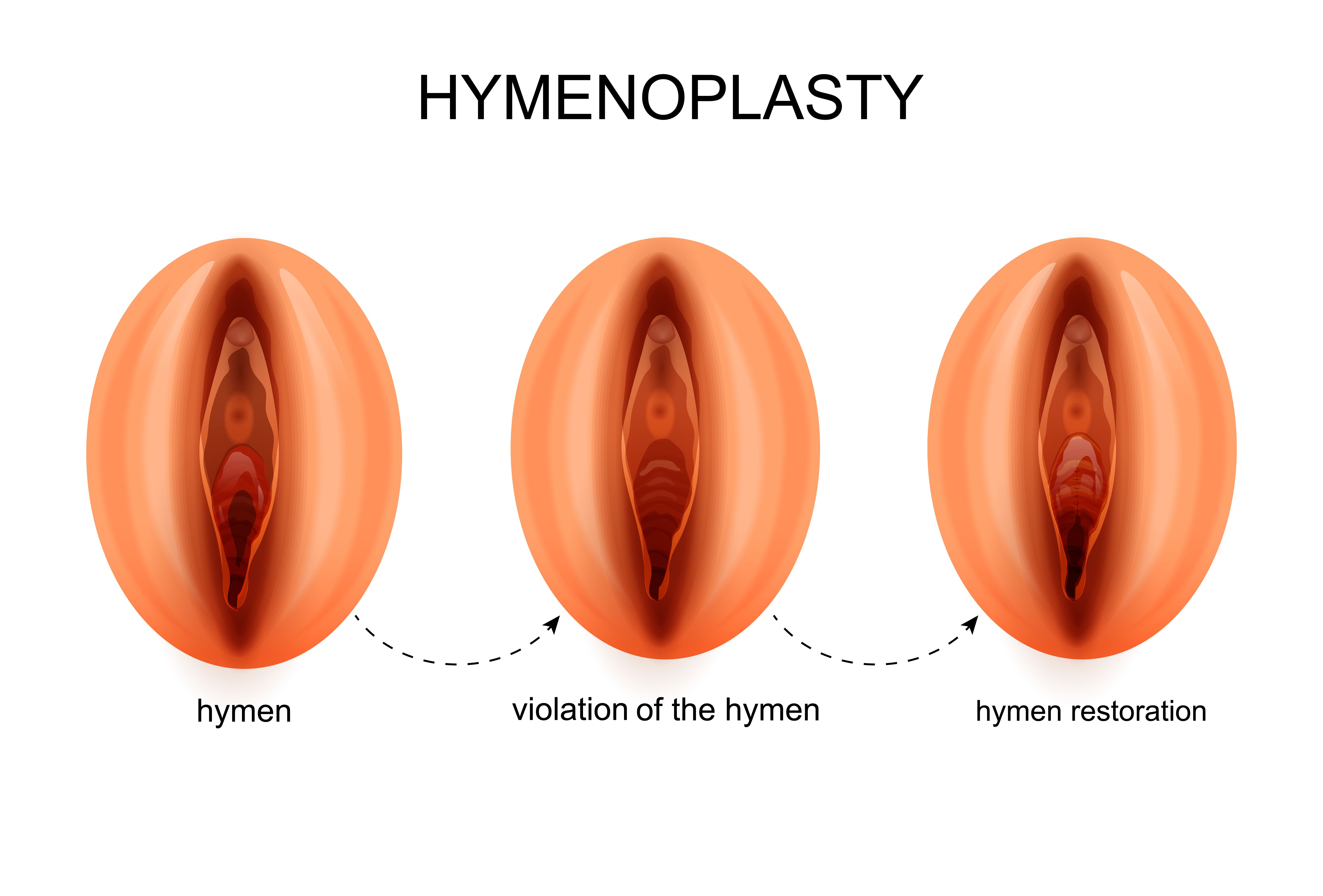 Himenoplastia
