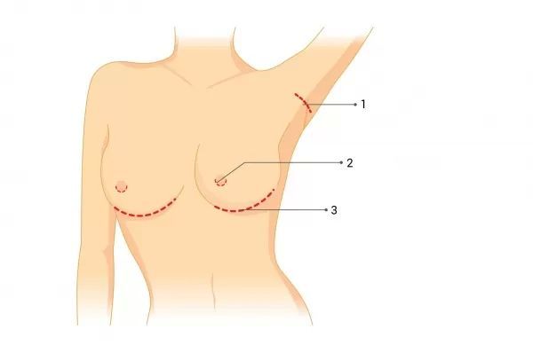 incisión aumento senos