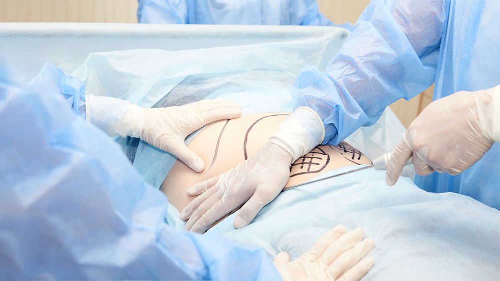 Procedimiento de liposucción ultrasónica
