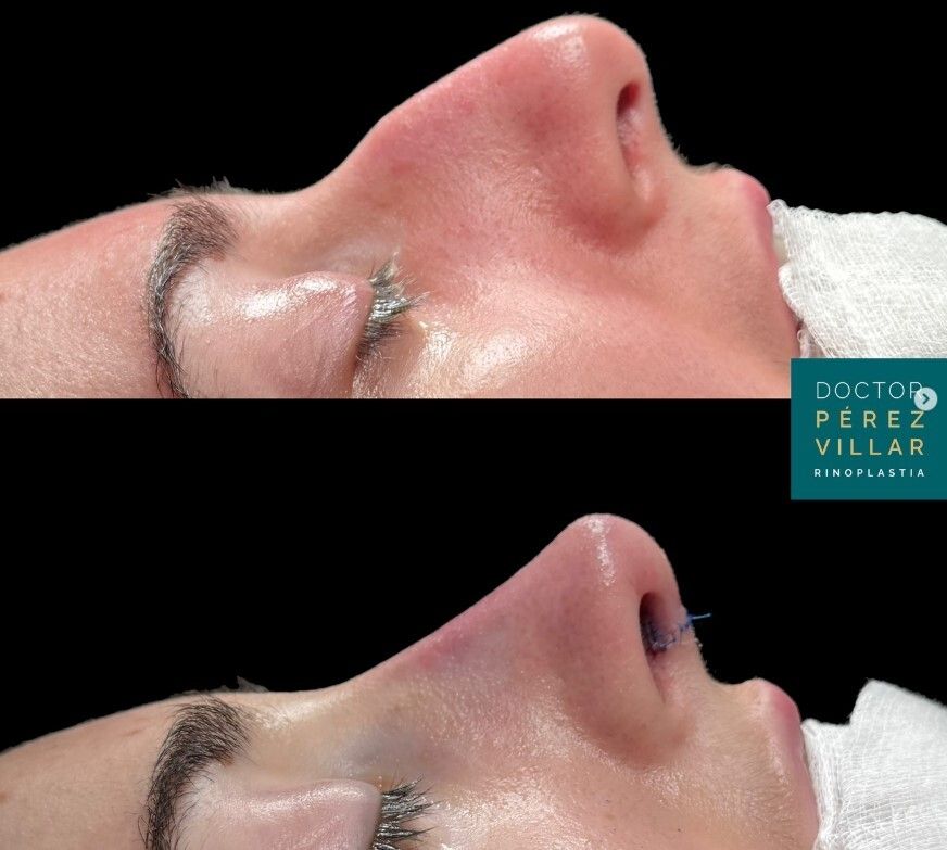 Rinoplastia ultrasónica