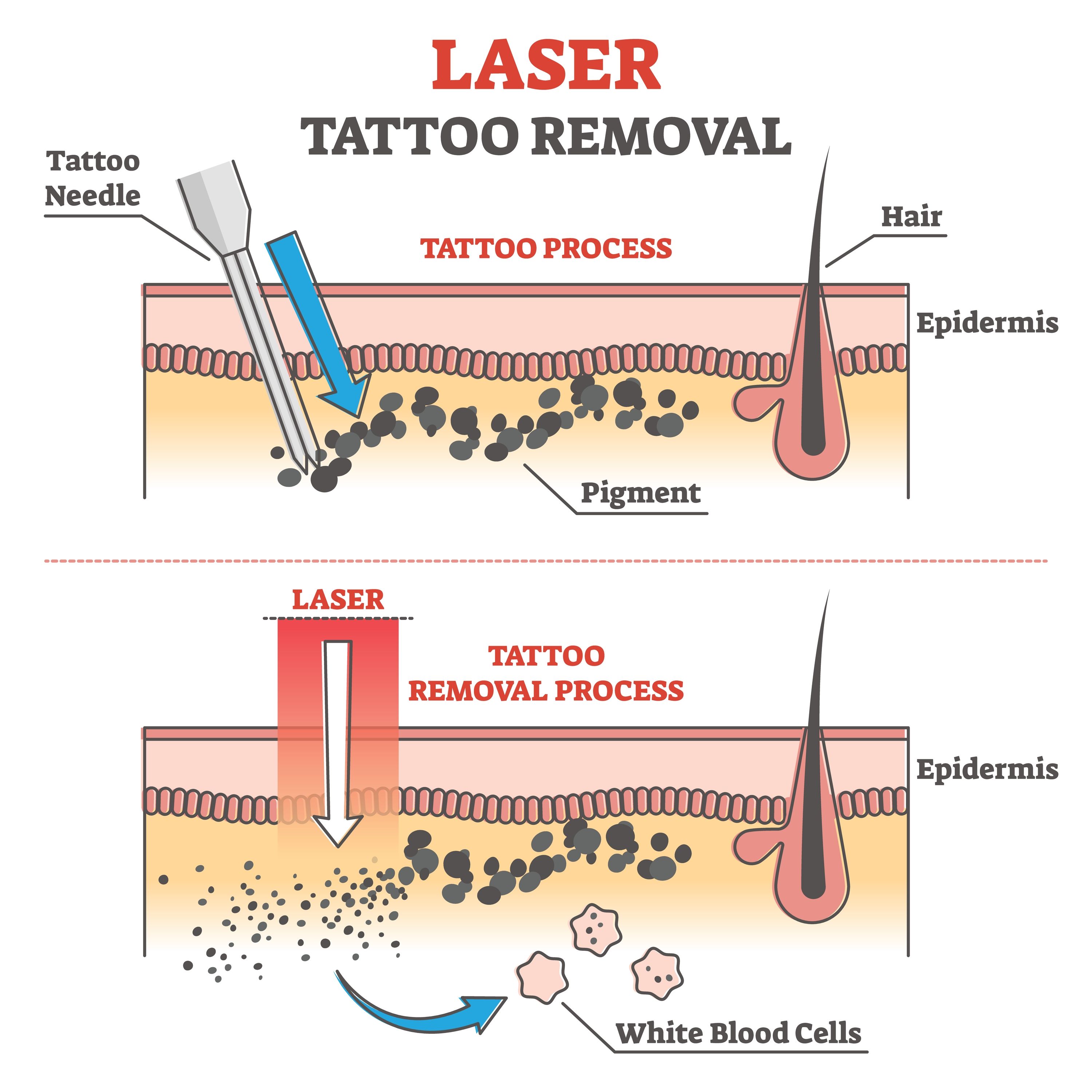 Laser borrado de tatuajes