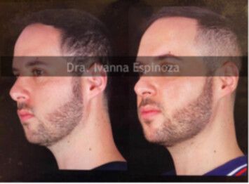 Bichectomía combinada con Lipotrasnferencia para Masculinización facial