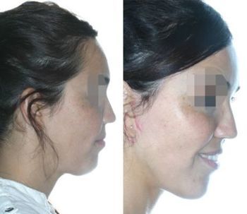 Antes y después de un lifting facial