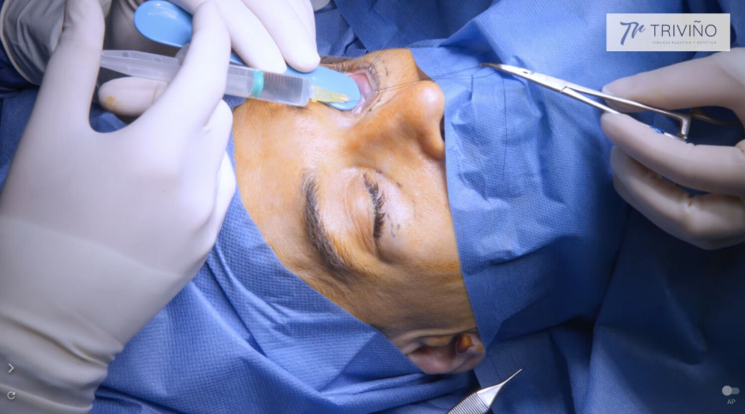 Blefaroplastia inferior
