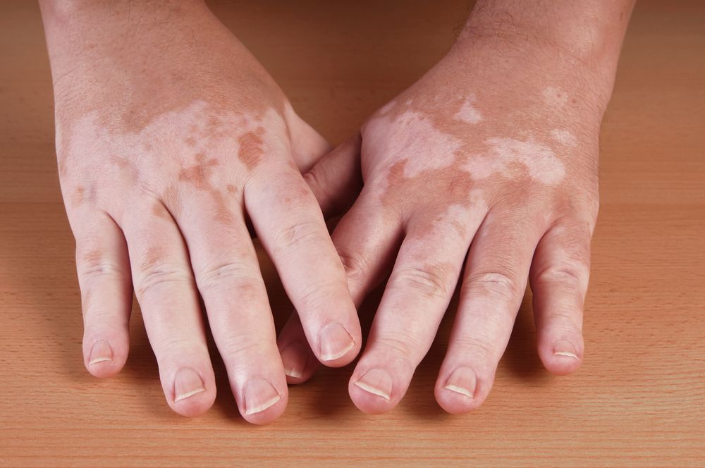 vitiligo causas