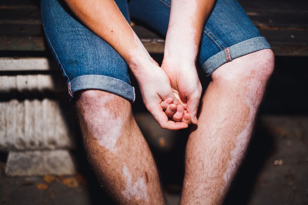 cómo se detecta el vitiligo