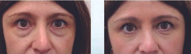 Blefaroplastia inferior antes y despues