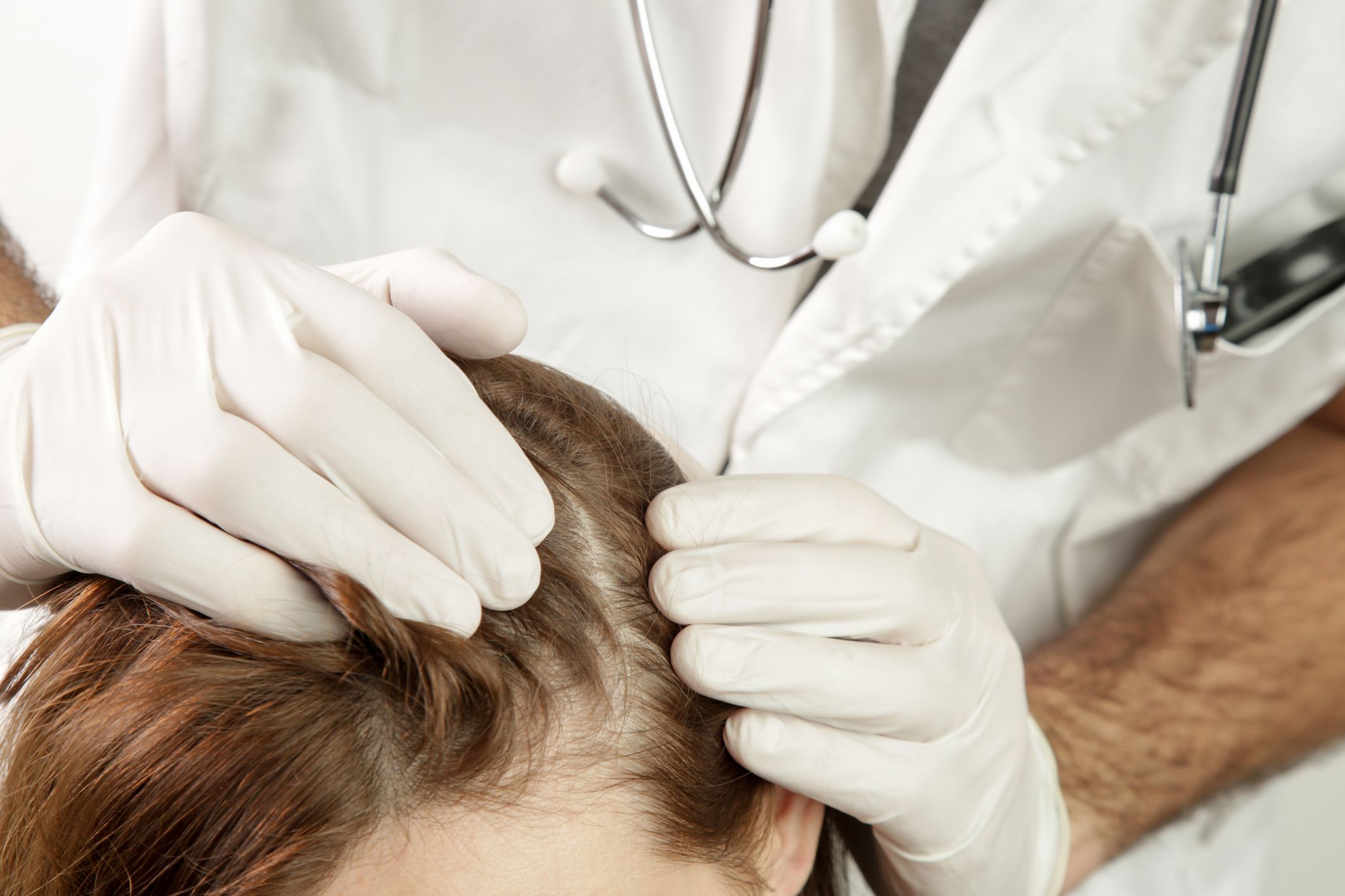 mesoterapia capilar