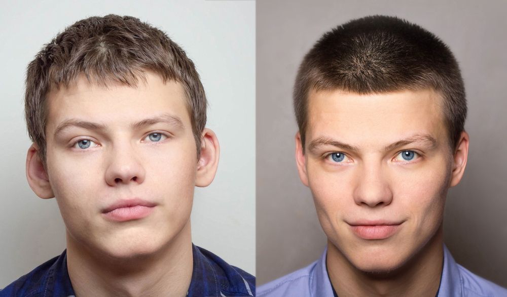 Antes y después de otoplastia
