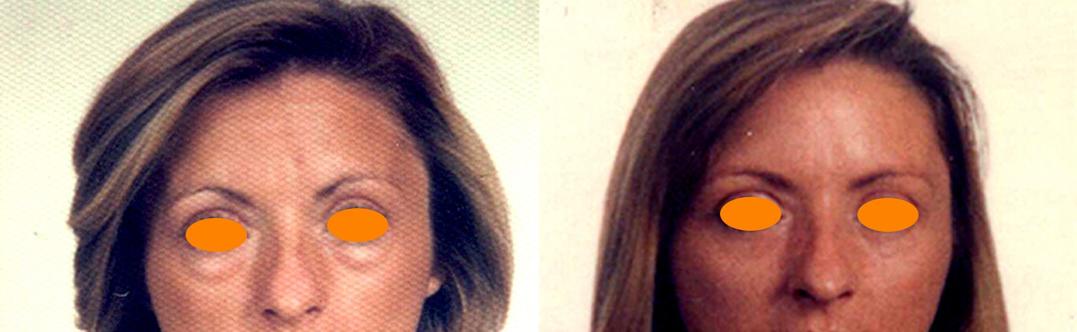 antes y después blefaroplastia