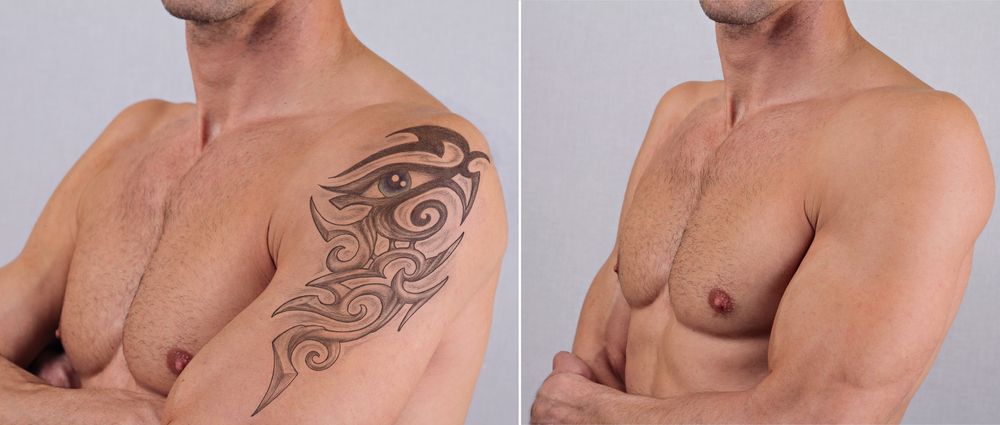 Antes y después eliminación de tatuajes