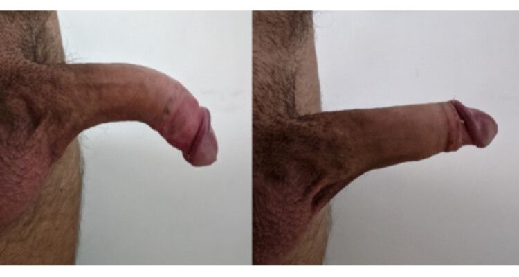 Antes y después de una curvatura de pene ventral
