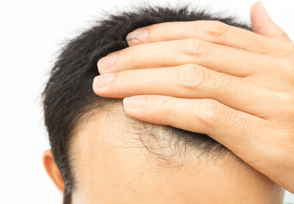 Alopecia en hombre