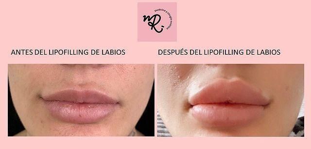 antes y después lipofilling labios
