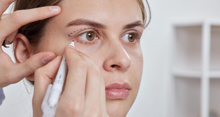 Blefaroplastia