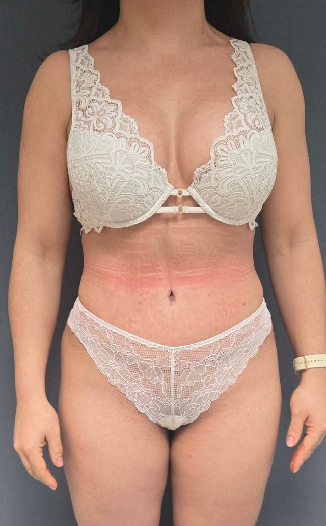 Abdominoplastia-mucho más que eliminar piel- Palacios Ortega