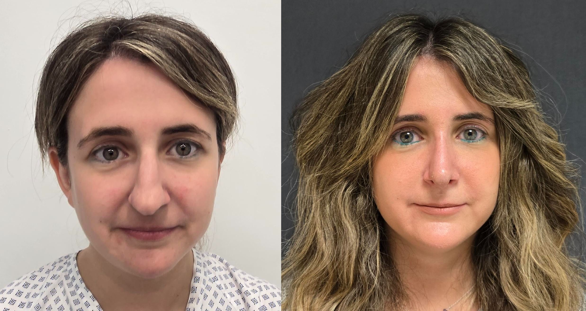 Antes y depsues rinoseptoplastia