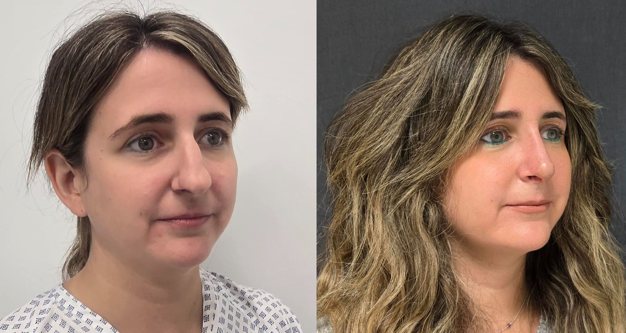 Antes y despues rinoseptoplastia