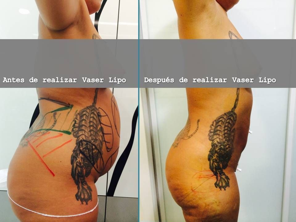 Antes y después de Vaser Lipo