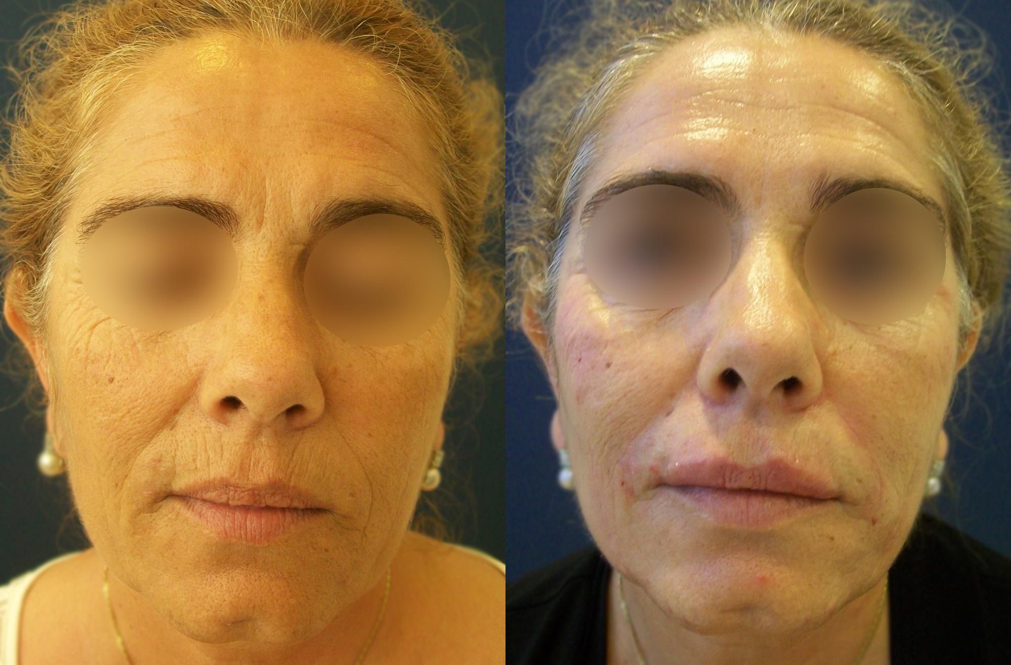antes y después vitaminas faciales