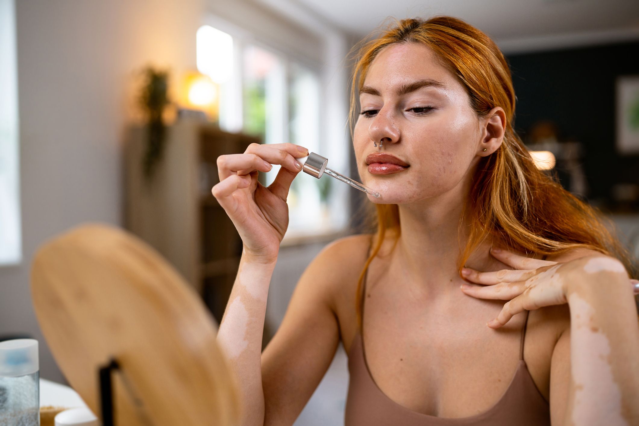 Tratamientos antiacné