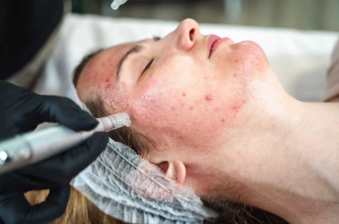 tratamientos antiacné
