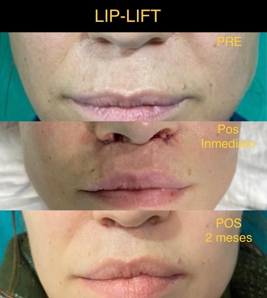 Antes y después Lip Lift