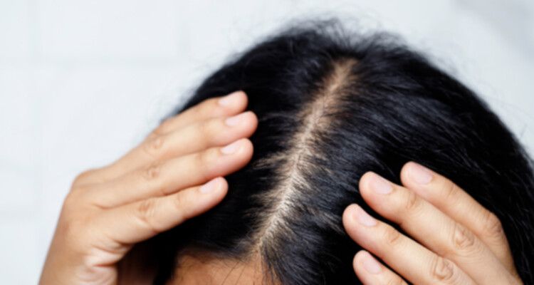 Alopecia