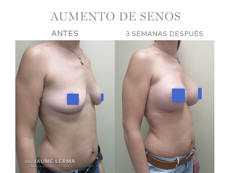 Antes y después aumento de pecho