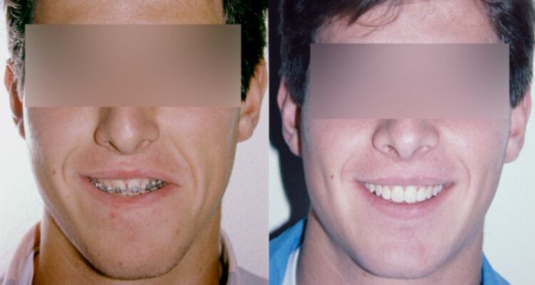 Antes y después de una cirugía ortognática