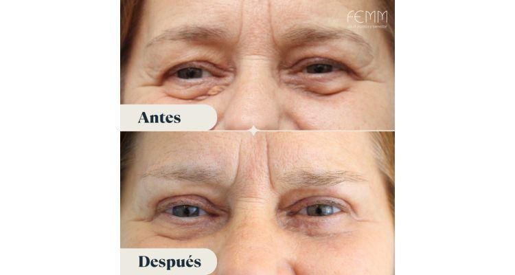 Antes y después blefaroplastia Clínica FEMM