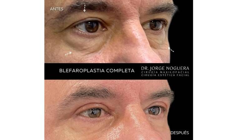 Antes y después de blefaroplastia.