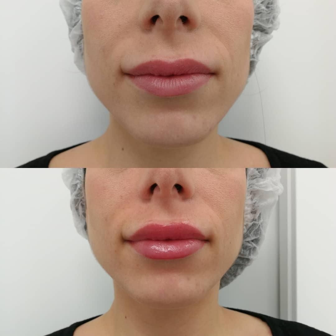 Antes y después hidratación de labios