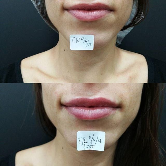 Antes y después relleno de labios con ácido hialurónico
