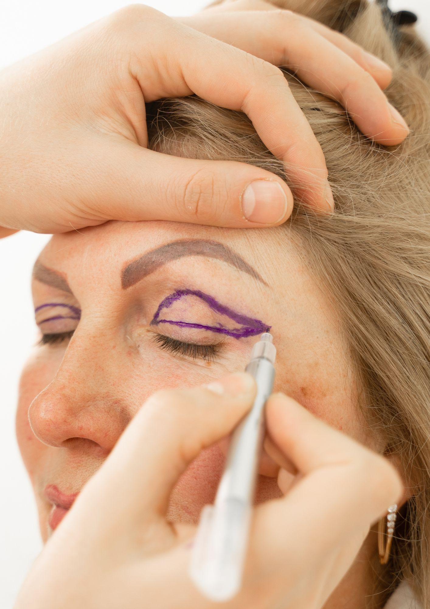 Blefaroplastia
