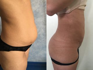 Abdominoplastia - Dra. Banacu Luminita