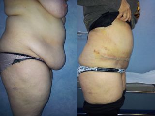 Abdominoplastia - Dra. Banacu Luminita