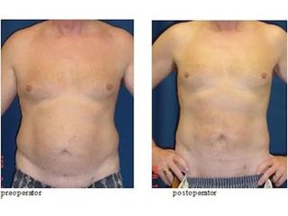 Liposucția, Lipoaspiratia, metodă chirurgicală de îndepărtare a grăsimilor