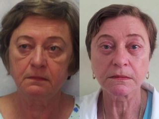 Liftingul facial înainte și după fotografii