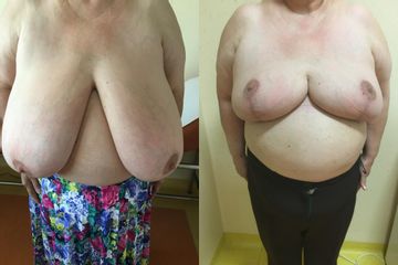reductie mamara in gigantomastie