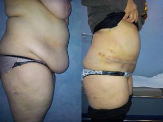 Abdominoplastie înainte și după imagine