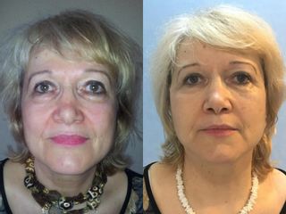 Liftingul facial înainte și după fotografii