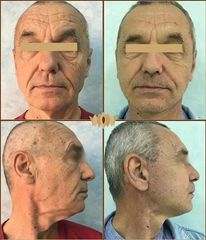 Lifting cervico-facial