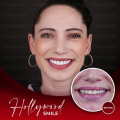 Blanqueamiento dental - Turkeyana Clinic
