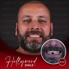 Implantes dentales - Turkeyana Clinic