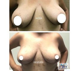 Reducción de Mamas